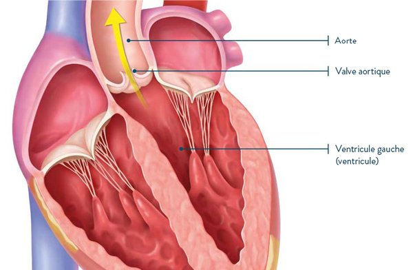 La sténose aortique et l’insuffisance aortique